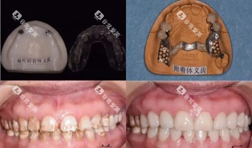 附着体一义齿全口展示