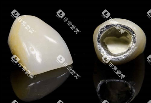 一颗烤瓷牙素材