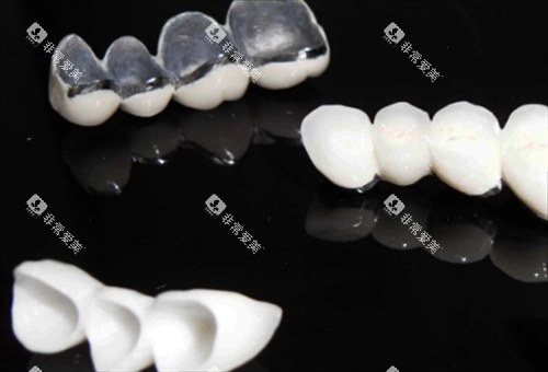 不同种类烤瓷牙模型展示