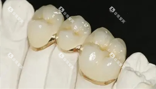 烤瓷牙安装成效展示图