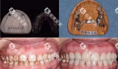 附着体一义齿全口展示