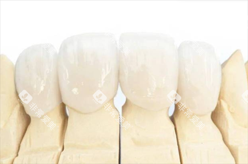 全瓷牙冠佩戴模型展示