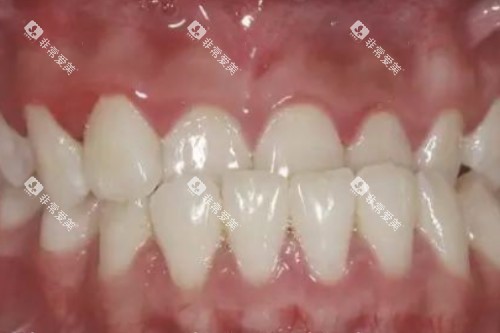 牙齿地包天卡通图