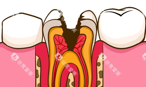 龋坏至牙髓展示