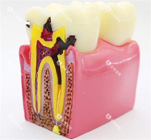 牙齿龋坏剖面图