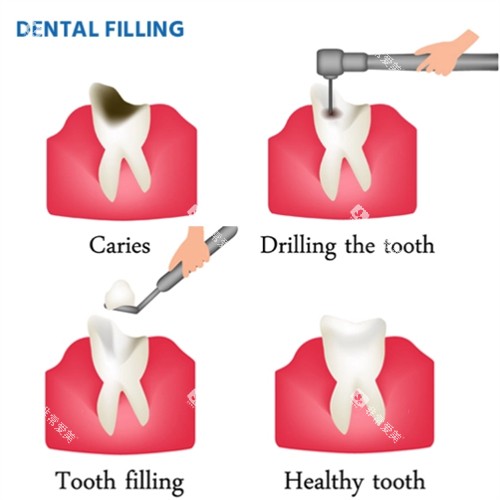 修复龋坏的牙齿