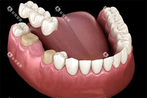 大牙5号牙缺牙桥冠修复
