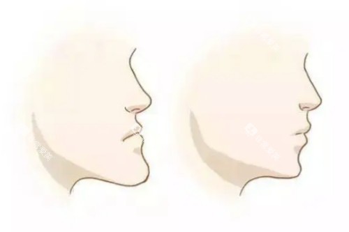 反颌卡通对比图