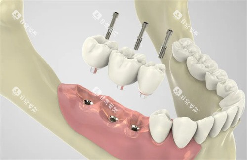 种植牙过程展示图片