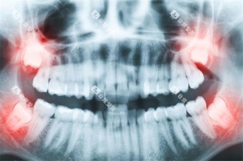 牙齿拍片图 牙齿拍片图