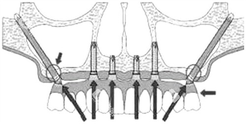 穿颧穿翼种植牙示意图