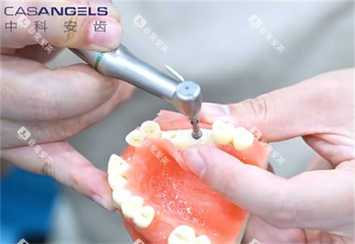 中科安齿种植牙钻孔