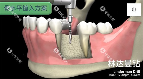 韩一种植体植入步骤