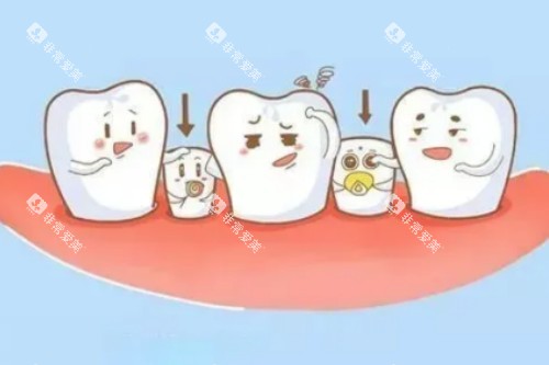 小孩子乳牙滞留卡通图