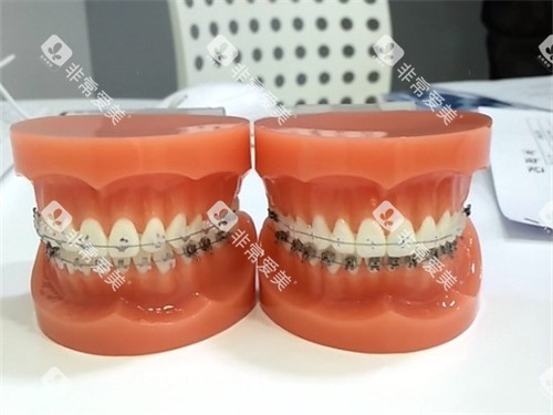 牙齿矫正牙套模型