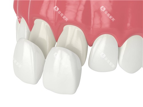 牙齿贴面安装 牙齿贴面安装