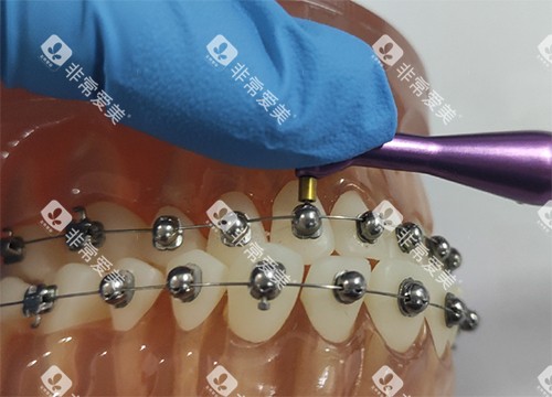 牙齿矫正OBrace球面托槽细节示意图