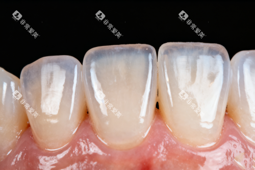 牙齿发黄卡通展示图 牙齿发黄卡通展示图