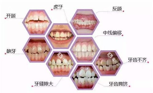 牙齿矫正适应症展示图 牙齿矫正适应症展示图
