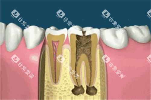 种植牙卡通展示图