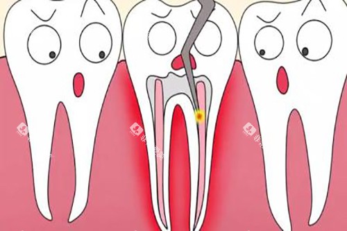 根管治疗卡通 根管治疗卡通