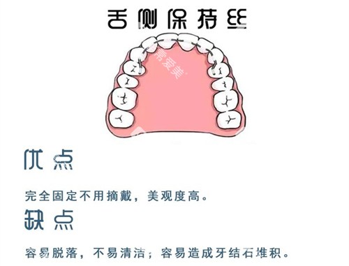 牙齿矫正舌侧保持器优缺点图