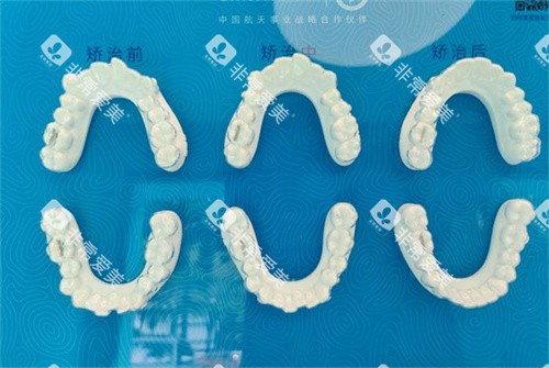 北京美笑口腔牙齿矫正成效对比图