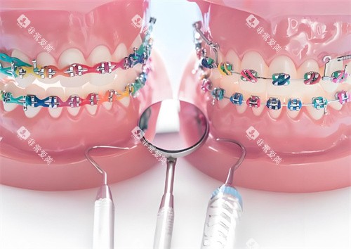 牙齿矫正模型图片