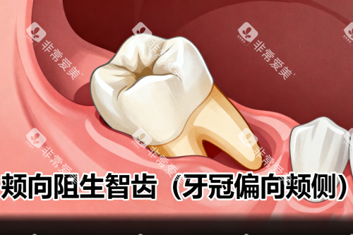 颊向阻生智齿展示图