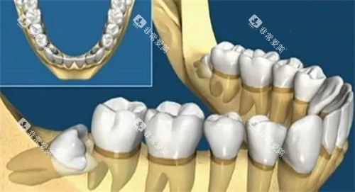 智齿牙齿动画图