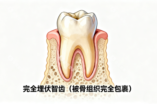 完全埋伏智齿展示图