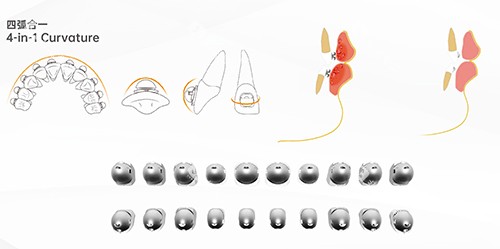 牙齿矫正OBrace球面全部托槽
