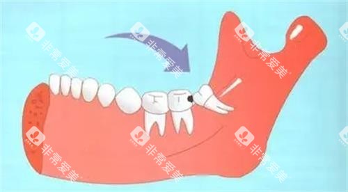 智齿的位置 智齿的位置