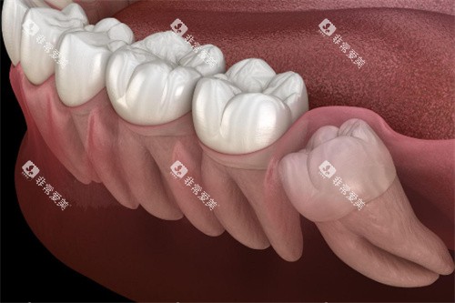 智齿示意图 智齿示意图