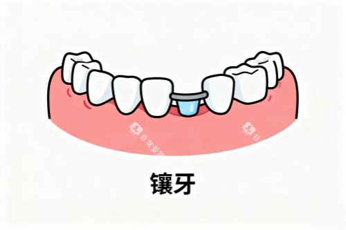 镶牙卡通图一览