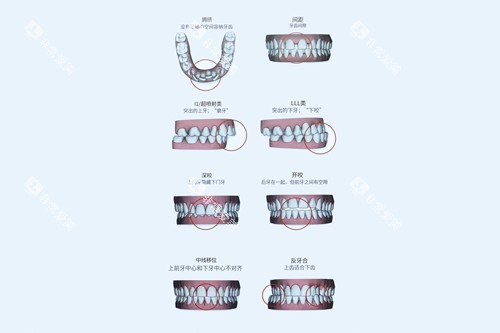 牙齿不齐的不同类型表现图