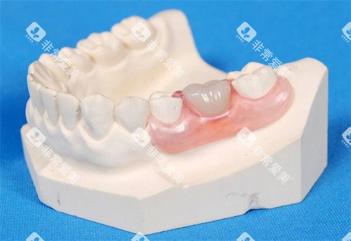 牙齿模型展示 图片