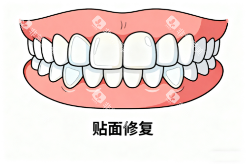 牙齿贴面修复卡通图