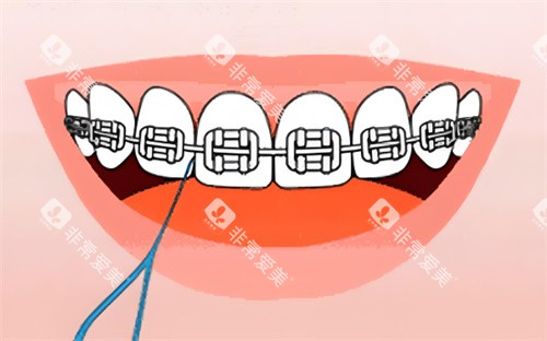 金属牙齿矫正卡通图片