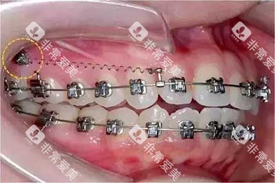 牙齿矫正骨钉种植钉2