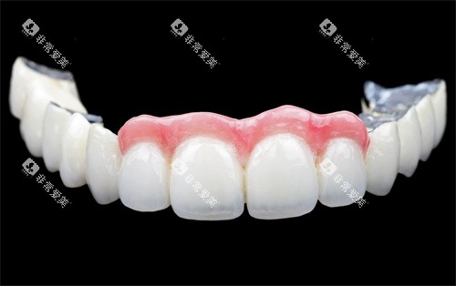 牙齿贴面展示jpg