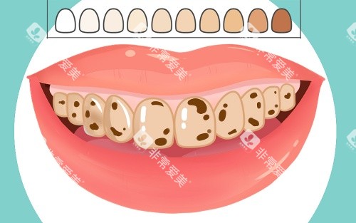 牙齿比色示意图