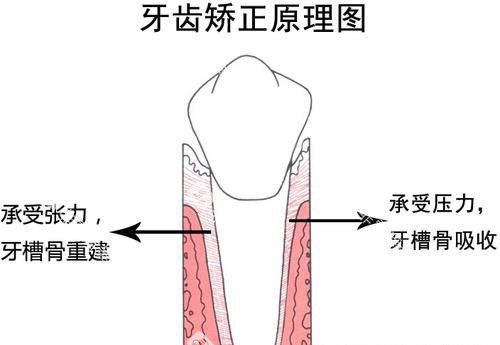 牙齿矫正正畸原理