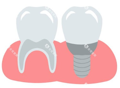 种植牙和牙齿图