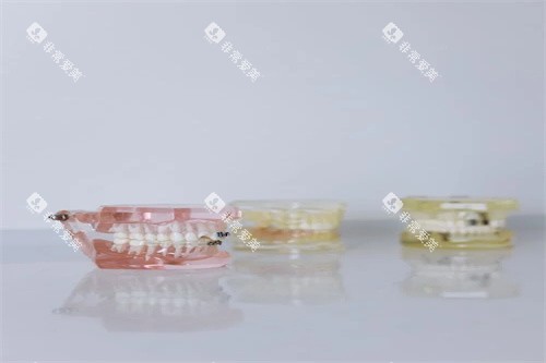 牙齿模型示意展示