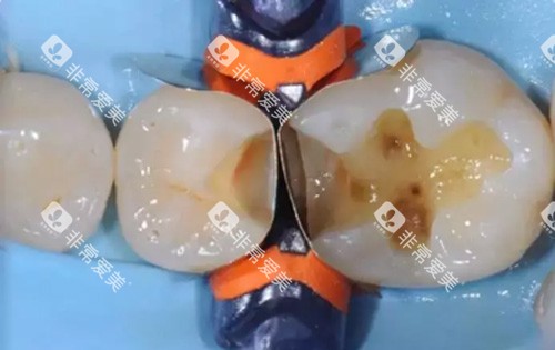 龋齿示意图 龋齿示意图