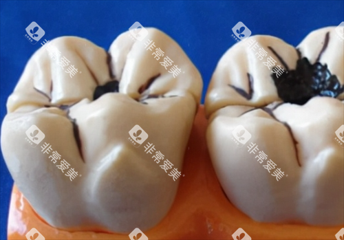 轻度和重度龋齿模型展示 轻度和重度龋齿模型展示