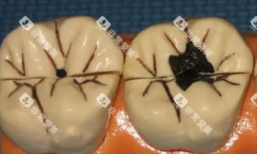 龋齿牙齿模型展示 龋齿牙齿模型展示