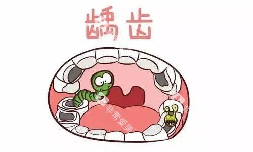 牙齿龋齿示意图 牙齿龋齿示意图