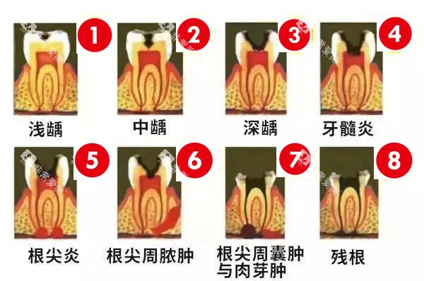 龋齿的情况 龋齿的情况